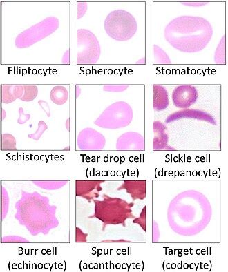 dacrocytes|Dacrocyte .